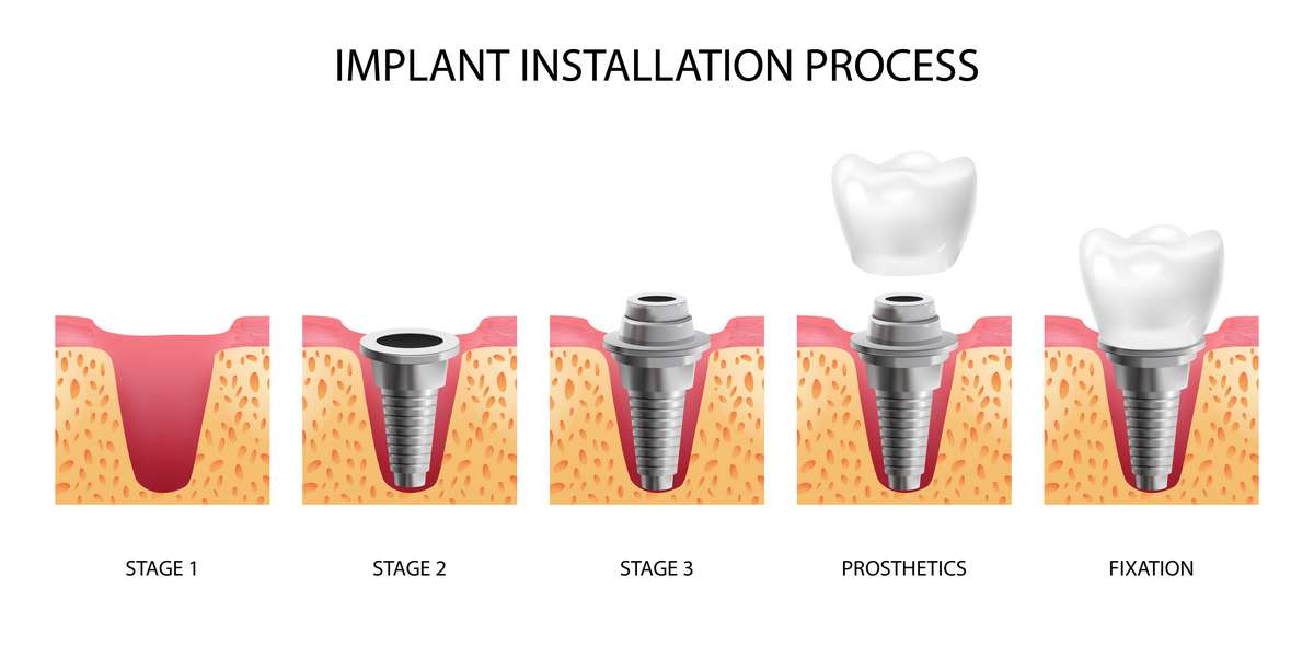 Schématický postup instalace zubního implantátu